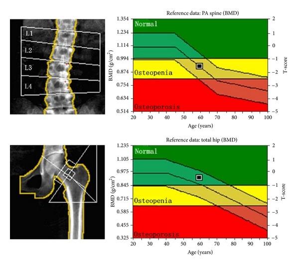 OSTEOPOROSIS